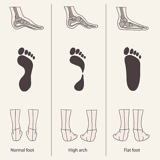 How Do I Know If I Have Flat Feet or High Arches?