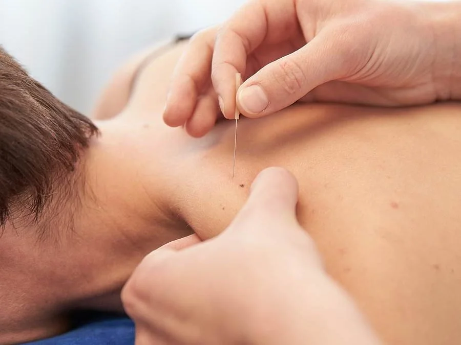 Understanding Dry Needling: The Science and Its Benefits