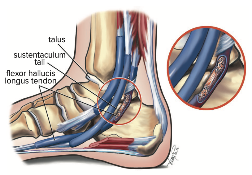 injury-to-flexor-hallucis-longus