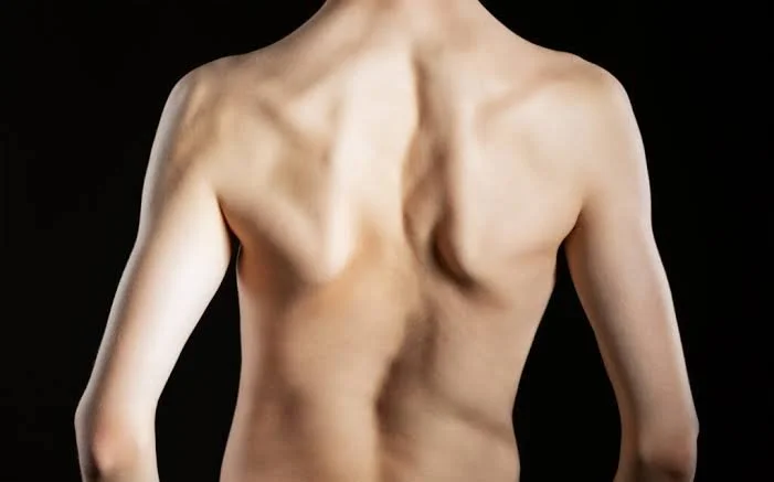 The Schroth Method: A Detailed Look at This Evidence-Based Approach for Scoliosis
