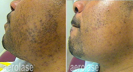 Folliculitis and PIH (Ingrown Hair)