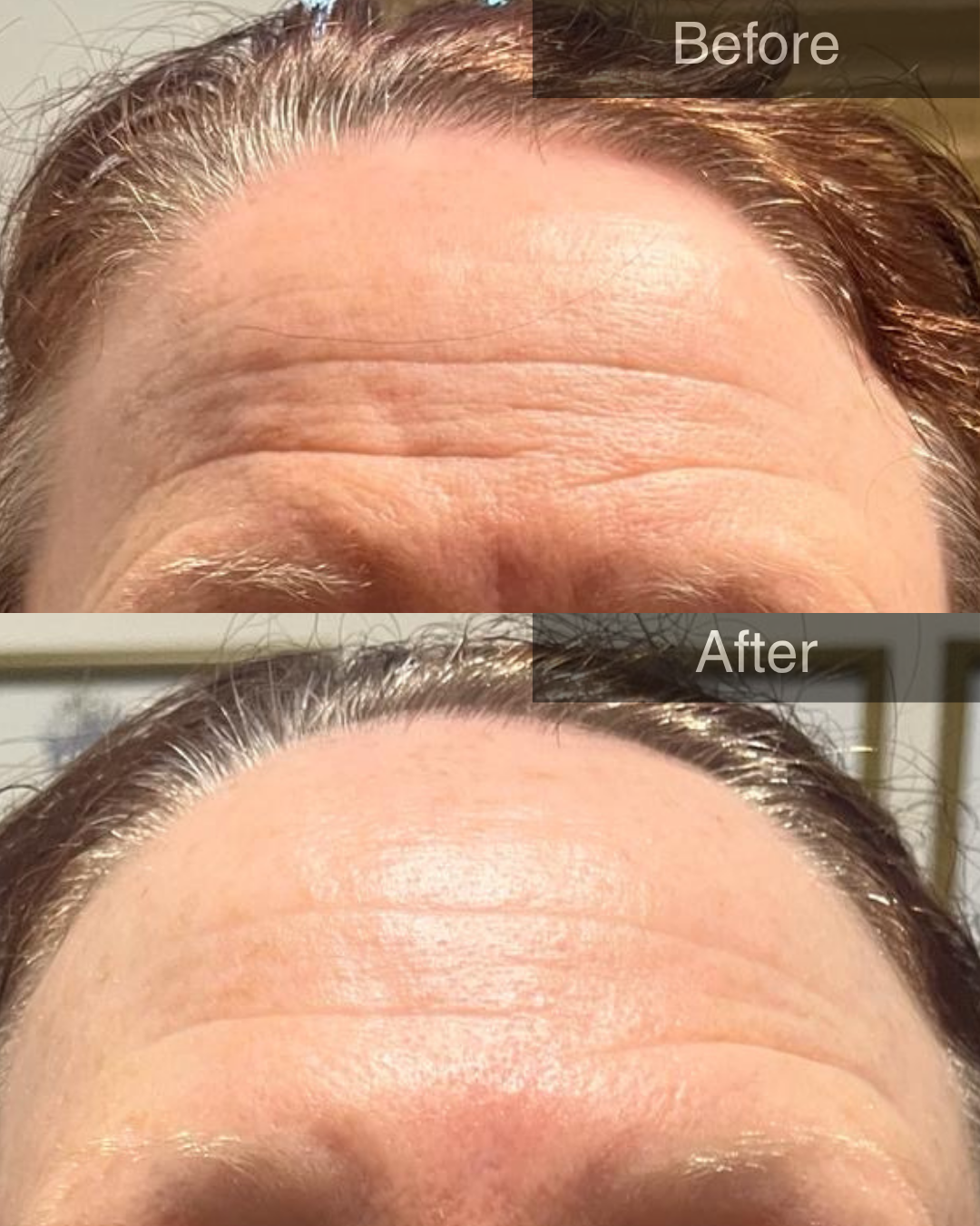 Client before and after photo with fewer lines post microdermabrasion treatment in Fernwood Newark.