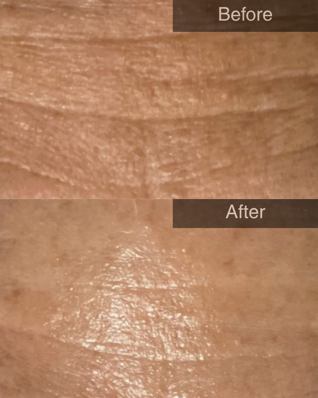 Image of client before and after hydrofacial forehead shot
