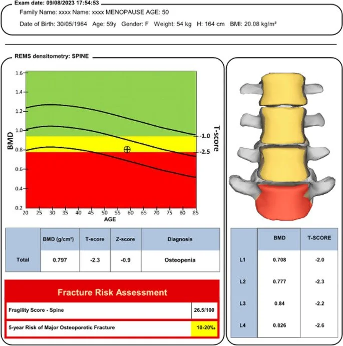 Bone density and spine health report showing age, gender, and BMI details. A graph of BMD scores across age, with a color-coded osteoporosis risk level. An illustration of the spine with vertebrae highlighted in yellow and red indicating areas of concern. Diagnostic information citing osteopenia, with fracture risk assessment and a 5-year osteoporosis fracture risk of 10-20%. Additional BMD and T-scores for different lumbar spine segments.