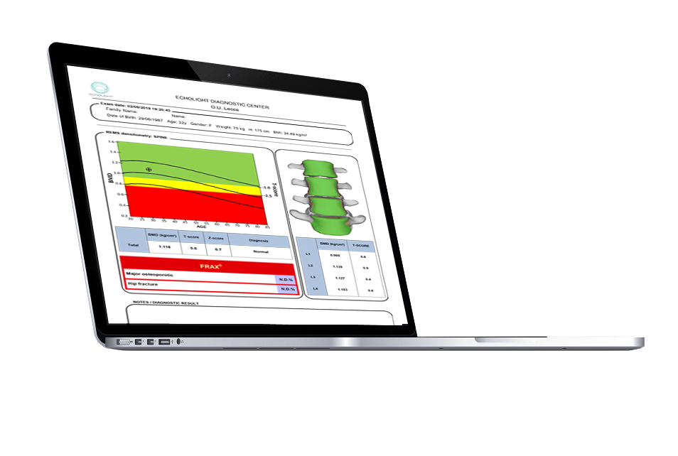 Laptop displaying medical diagnostic report with spinal images and a graph.