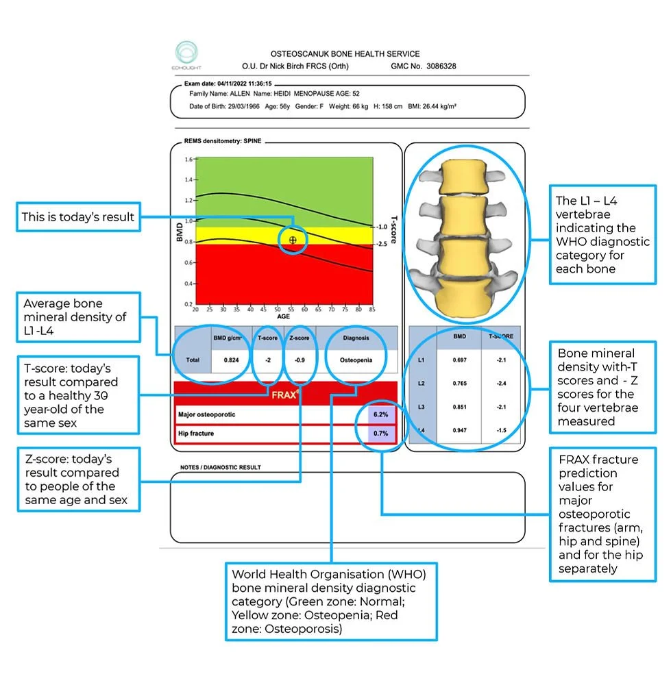 A medical report from displaying a patient's bone density results. The report includes a densitometry graph, a diagram of the spine, and numerical bone density scores for the L1-L4 vertebrae. It also notes the patient's age, gender, and BMI, and provides diagnostic categories for osteoporosis and osteopenia based on WHO guidelines.