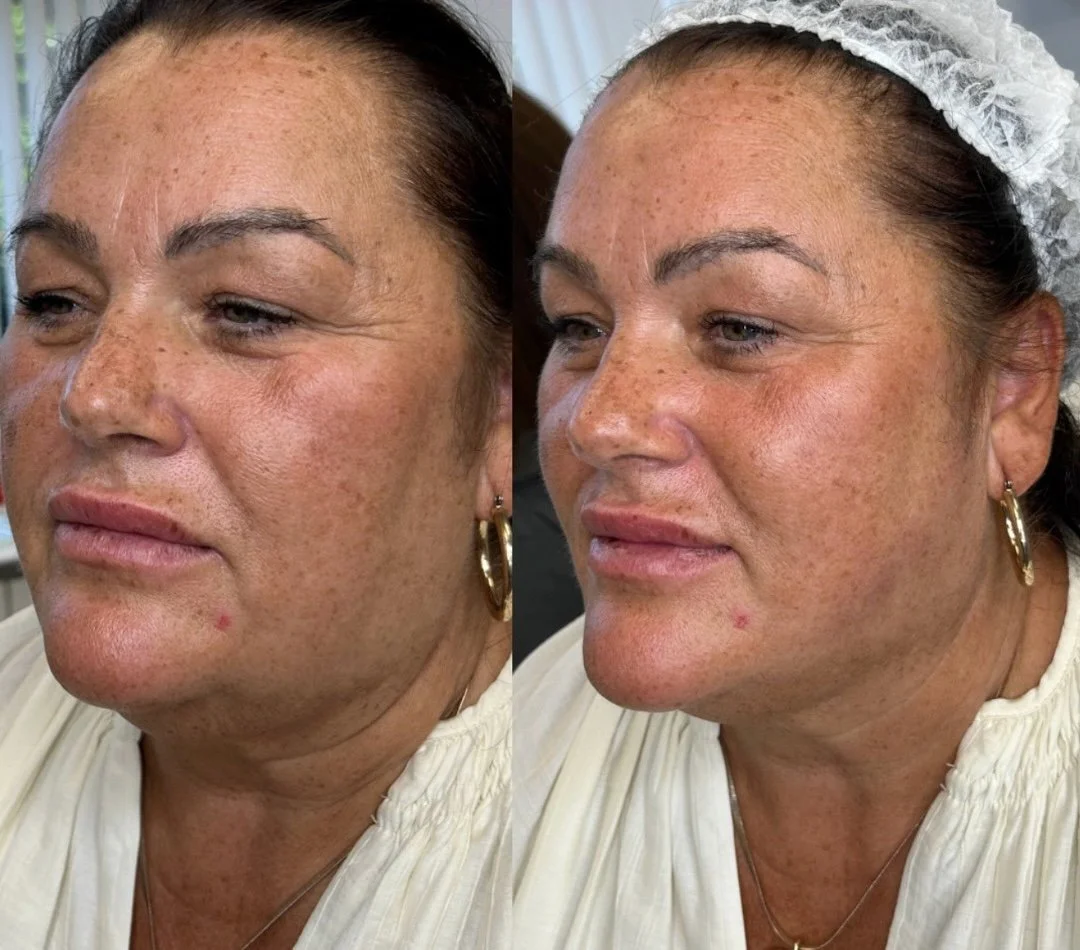 Before and after images of a woman showing improved skin texture and pigmentation, likely as a result of a skincare treatment or procedure.