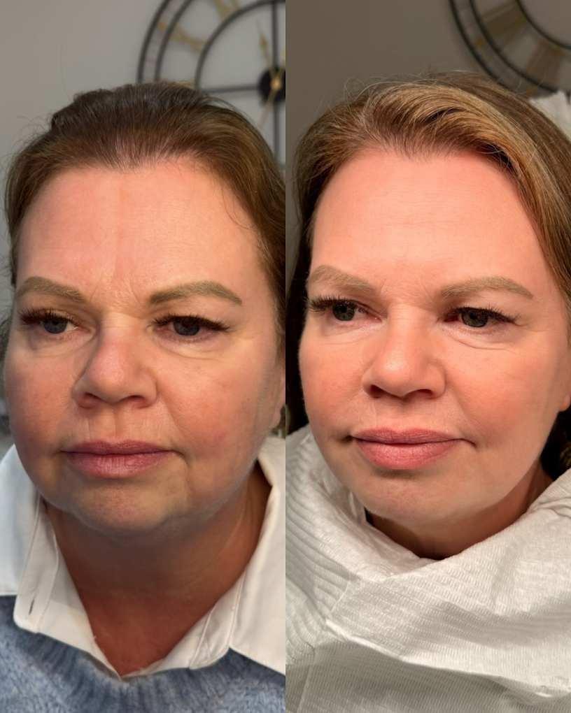 Side-by-side comparison of a woman's face before and after cosmetic treatment, showing smoother skin and subtle improvements.