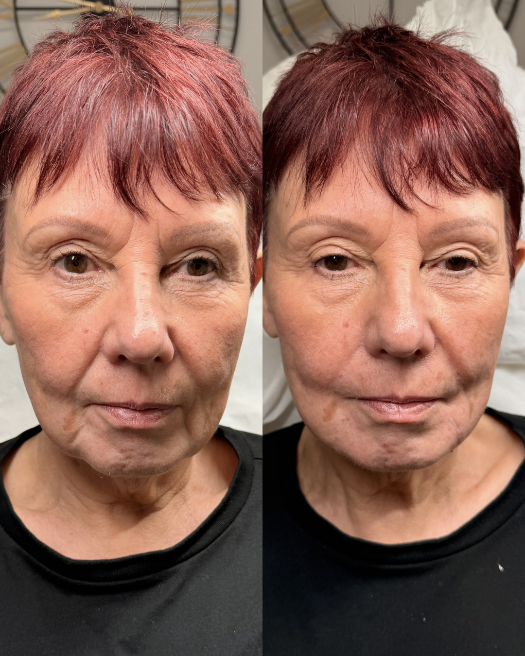 Side-by-side comparison of a woman with red hair, showing her before and after a cosmetic procedure or treatment, with visible skin improvements.