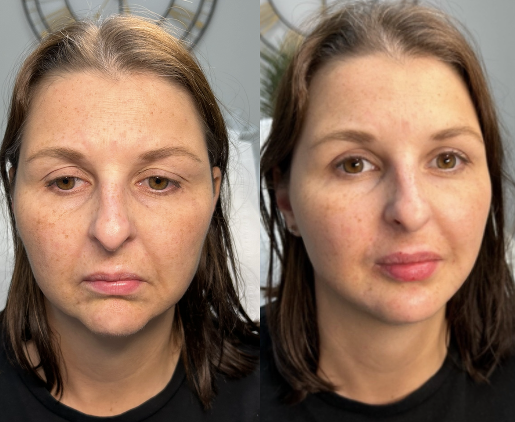 Comparison of a woman with facial acne and hyperpigmentation before and after skincare treatment, smiling slightly in the after photo.