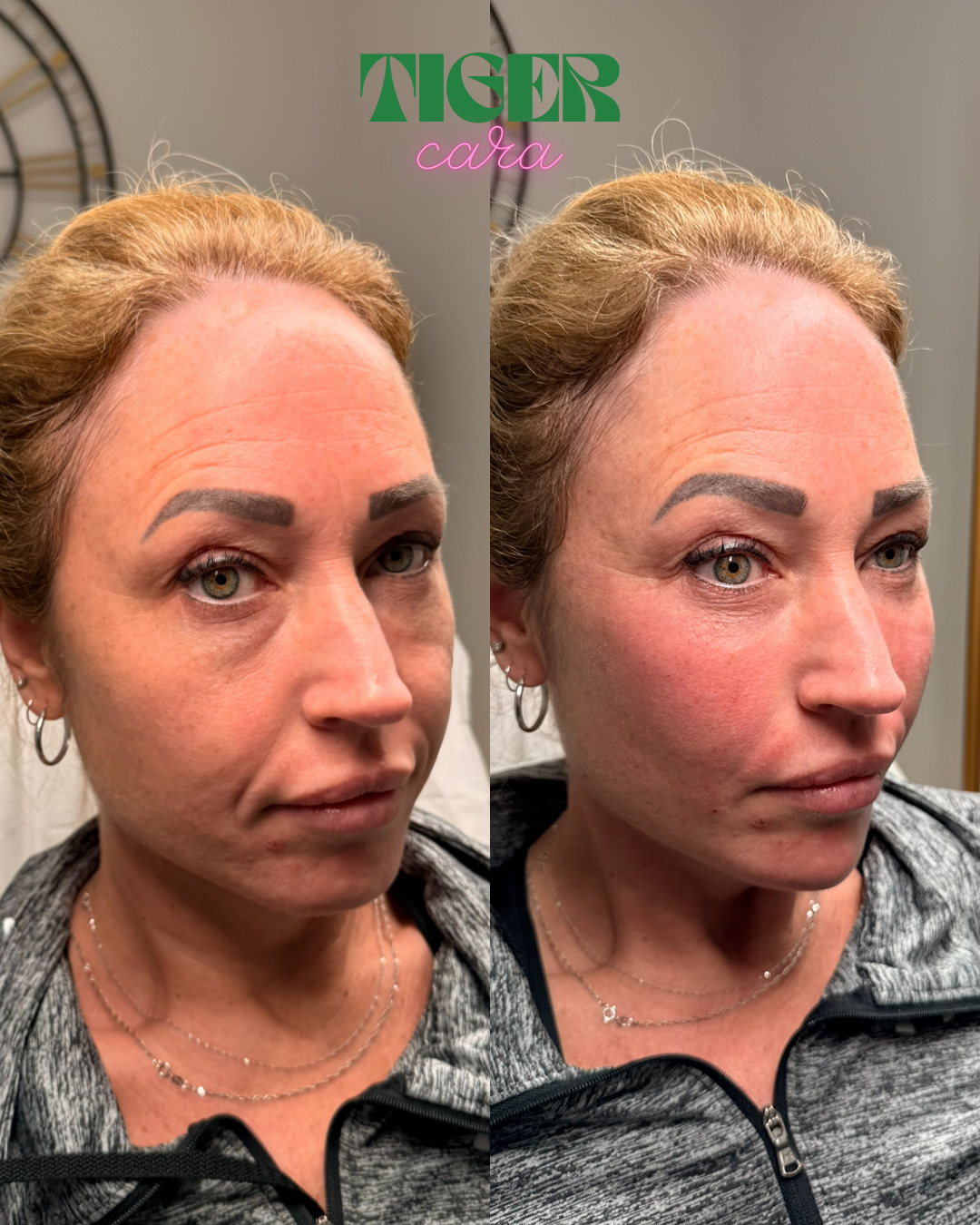 Biofiller: The Natural Alternative to Dermal Fillers