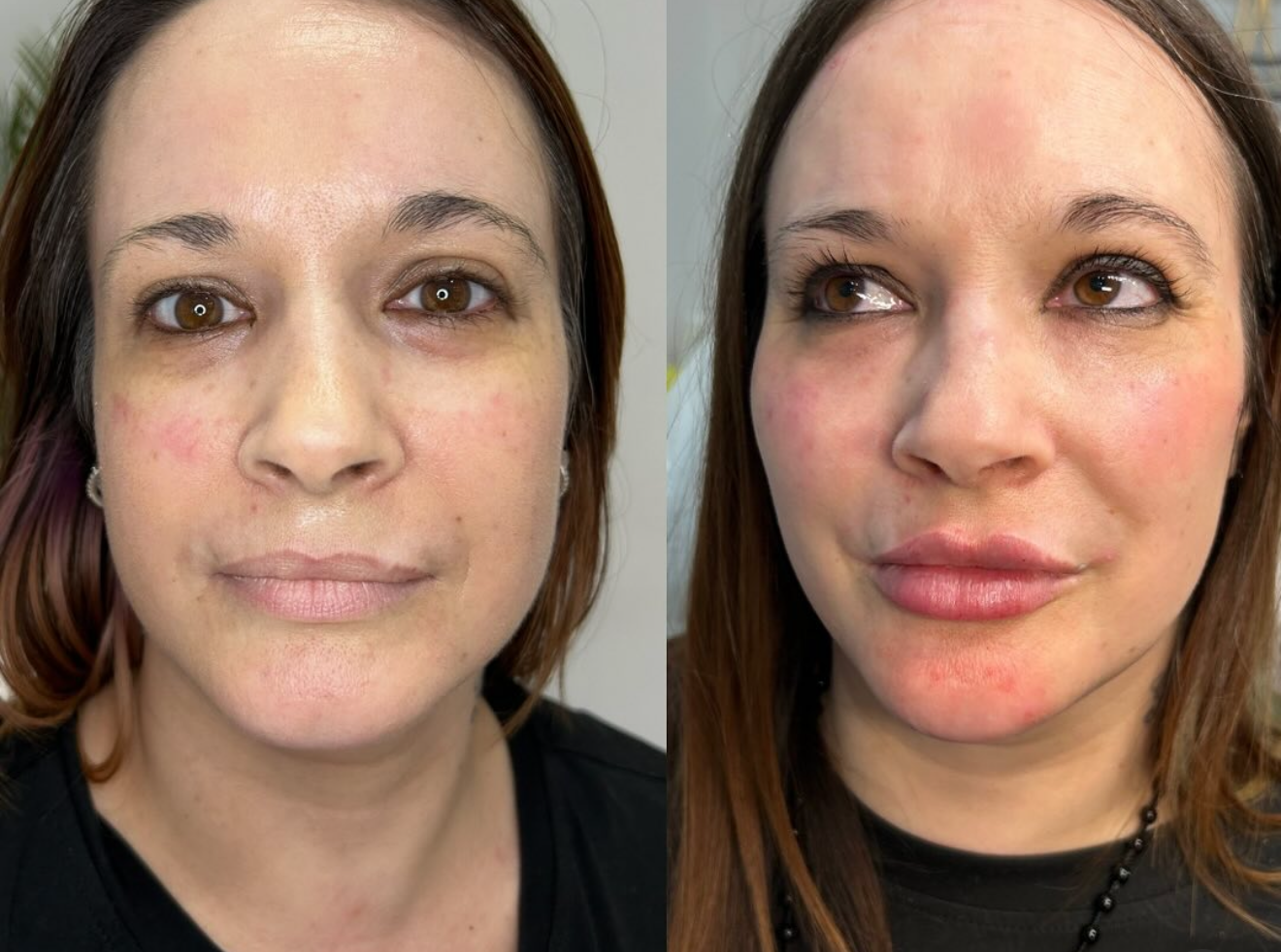 Side-by-side comparison of a woman's face before and after skincare or cosmetic treatment, showcasing improvements in skin texture, redness reduction, and lip enhancement.