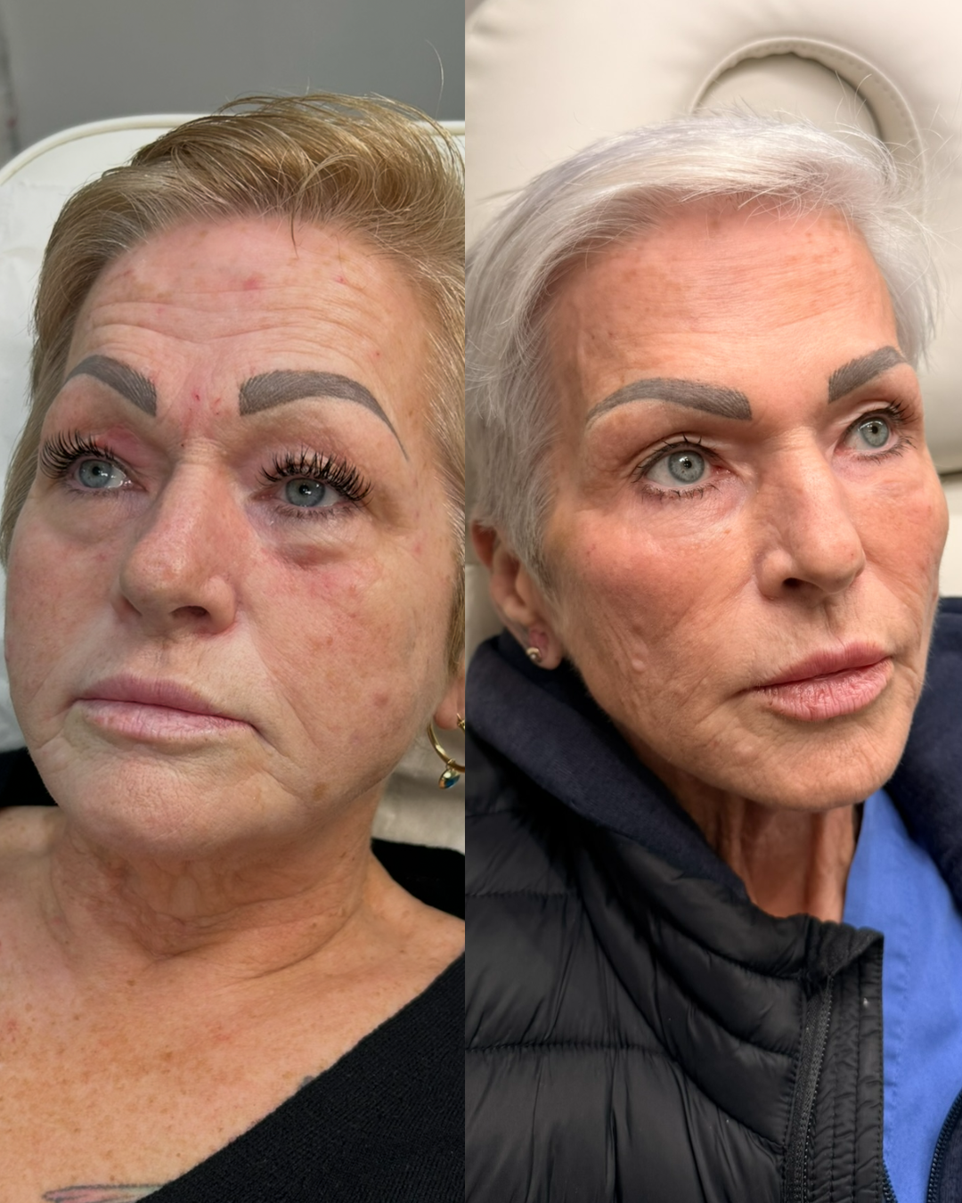 Side-by-side comparison of a woman before and after skincare or cosmetic treatment, showing improvement in skin texture and appearance.