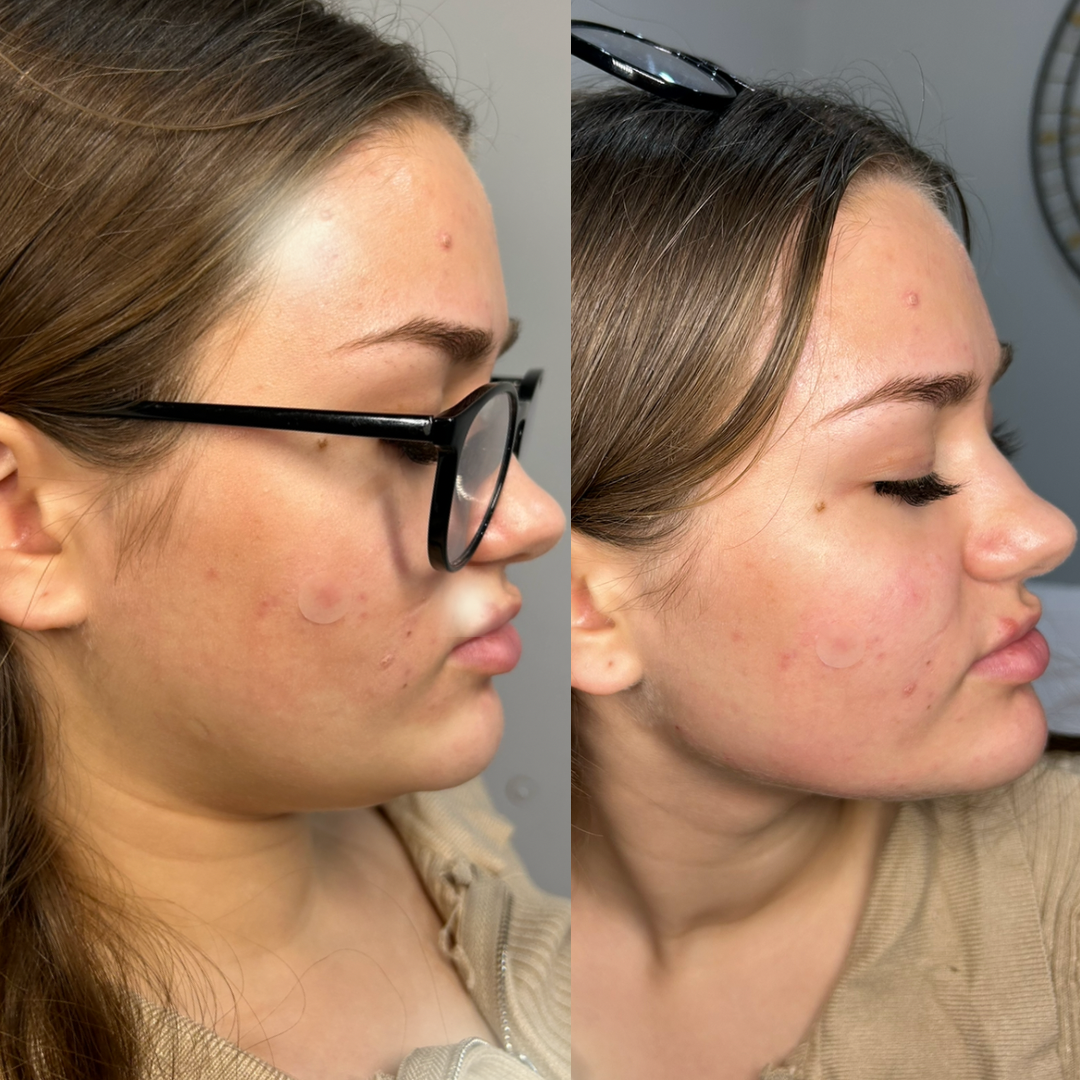 Side by side comparison of a woman's face before and after skincare treatment showing reduced acne and skin redness.