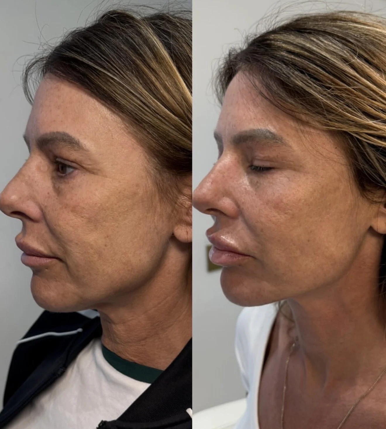 Side-by-side comparison of a woman’s face before and after skincare or dermatological treatment, showing improvements in skin texture and appearance. Skin tightening using pdo cog threads.
