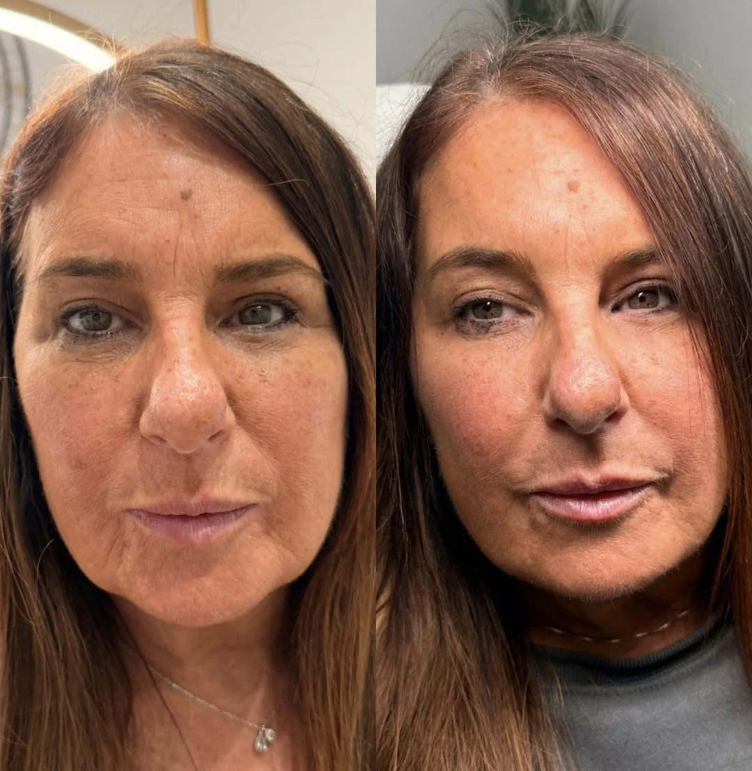 Side-by-side comparison of a woman with visible skin concerns before and after skincare treatment, showing reduced redness and improved skin texture.