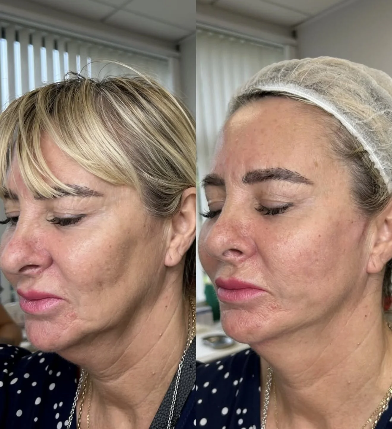 Before and after close-up photos of a woman's face showing skin improvements, with the woman wearing a hair cover in the after photo.