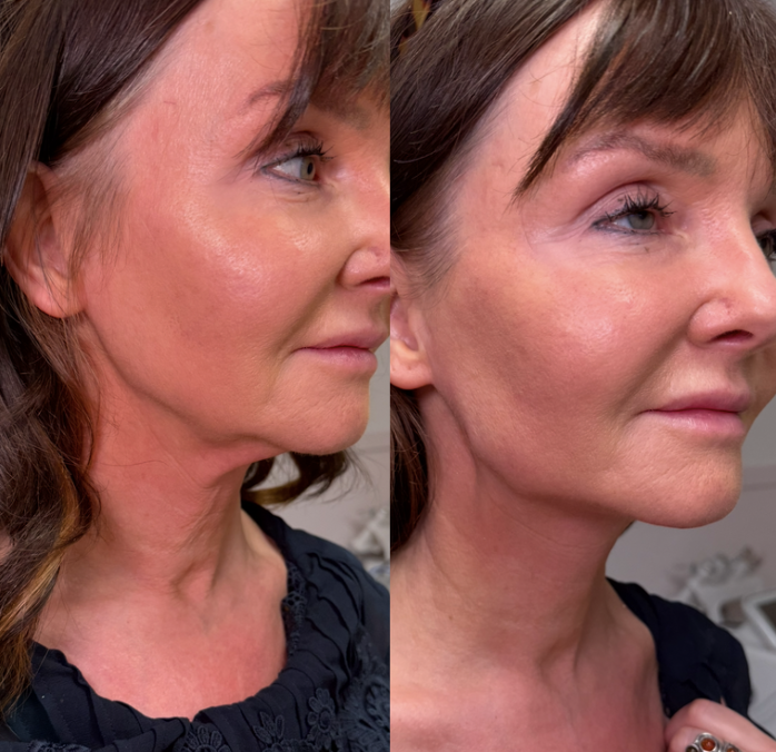 Side-by-side comparison of a woman's face before and after a skincare treatment, showing smoother and more radiant skin in the after photo.
