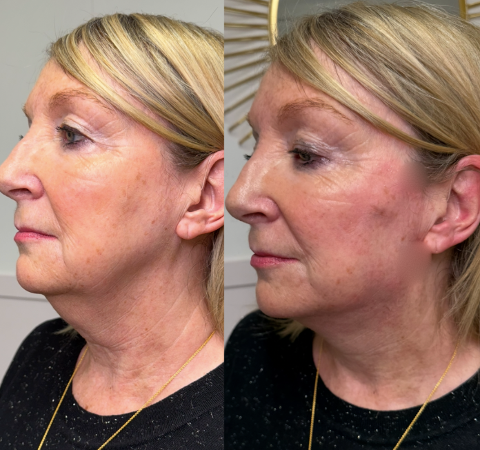 Side-by-side comparison of a woman's face showing skin improvements, revealing before and after skin treatment results.