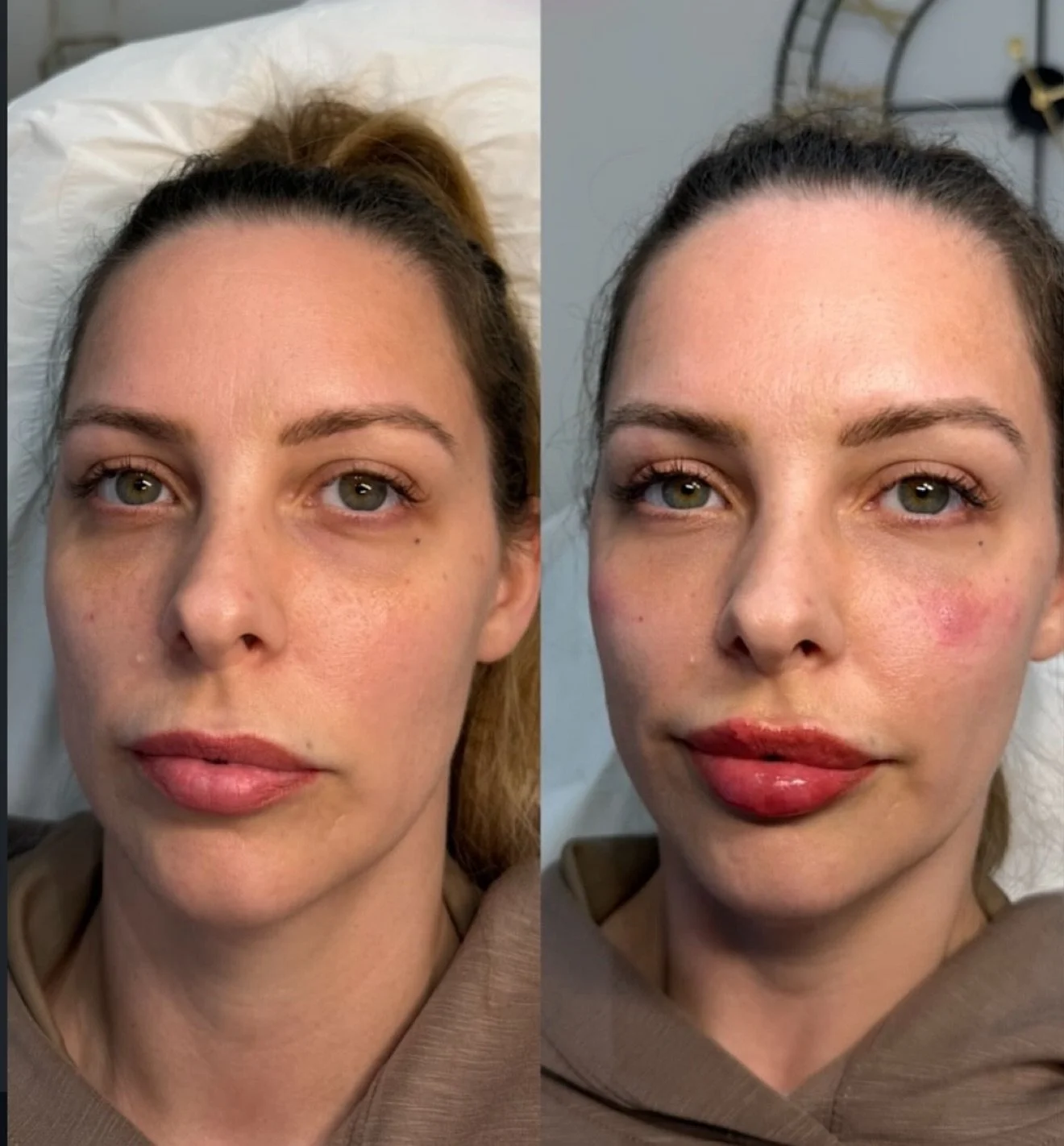 Side-by-side comparison of a woman's face before and after cosmetic treatment, showing improvements in skin texture, redness, and lip appearance.