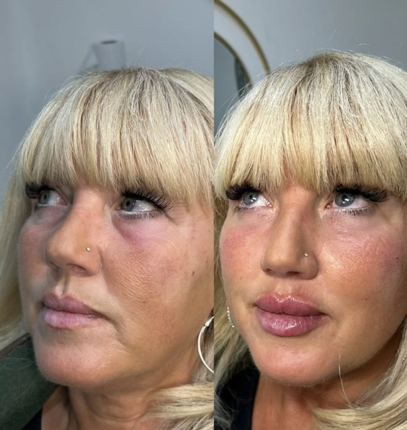 Side-by-side comparison of a woman with blonde hair and bangs before and after a beauty treatment, showing improved skin texture and fuller lips.