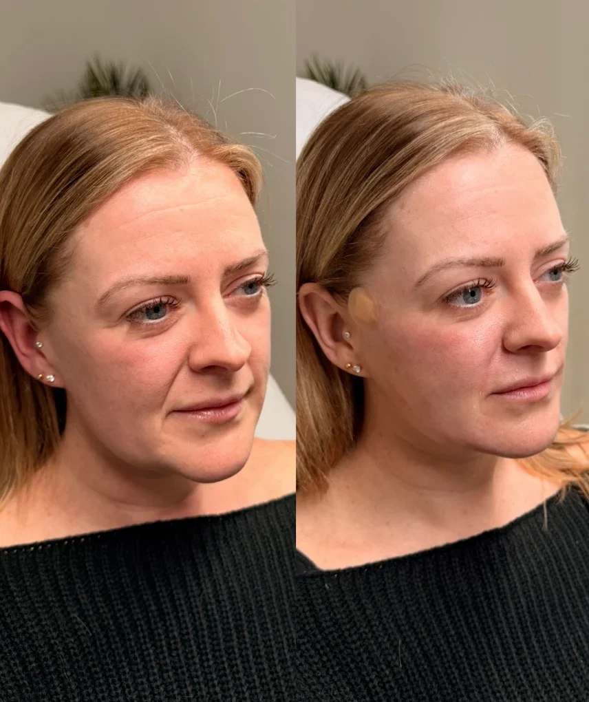 Side-by-side comparison of a woman's face before and after a cosmetic procedure, showing skin texture and facial features.