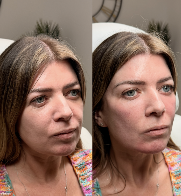 Side-by-side comparison of a woman's face, showing her before and after facial treatment with noticeable skin improvement.