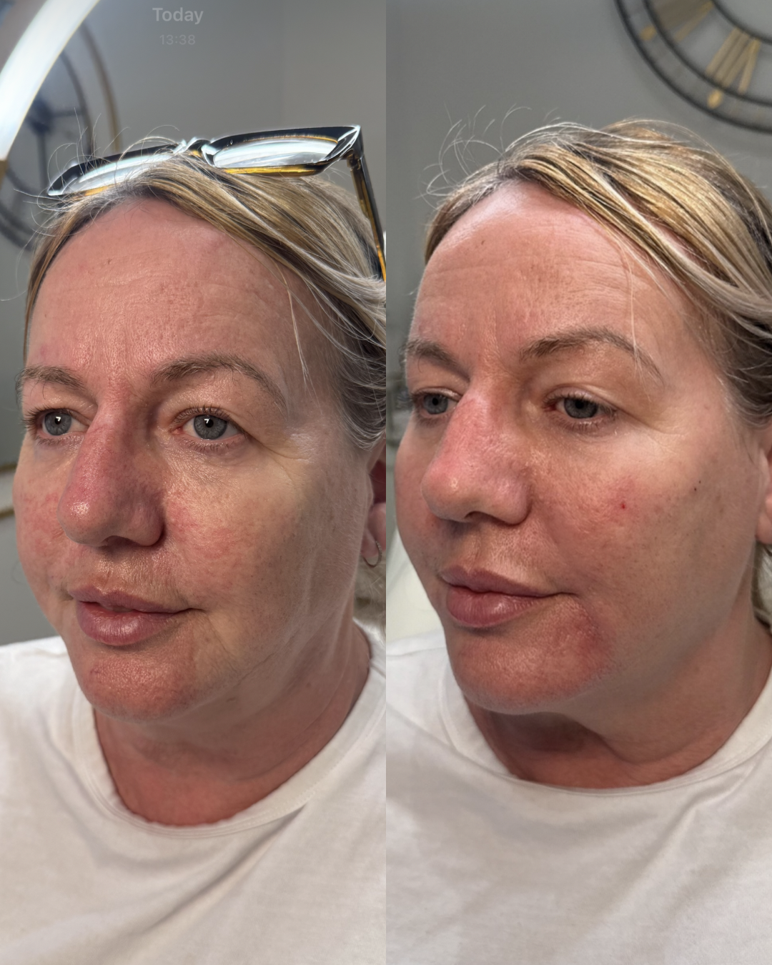 Side-by-side comparison photo of a woman showing skin before and after skincare or treatment, with visible improved skin texture and redness reduction.