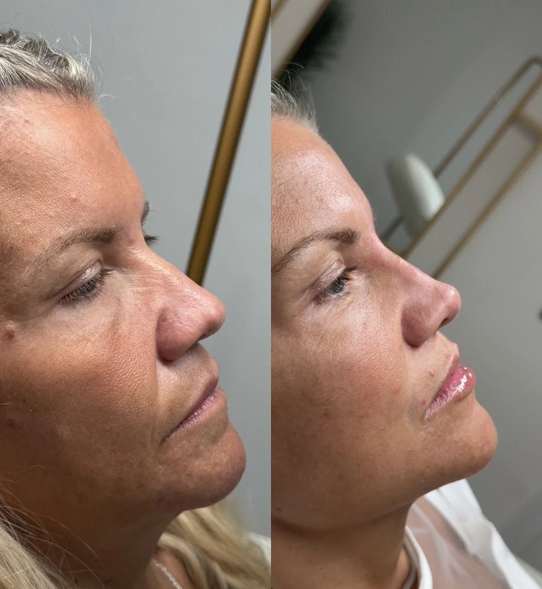 Side-by-side comparison of a woman's face showing before and after skin treatment, highlighting improved skin texture and tone.