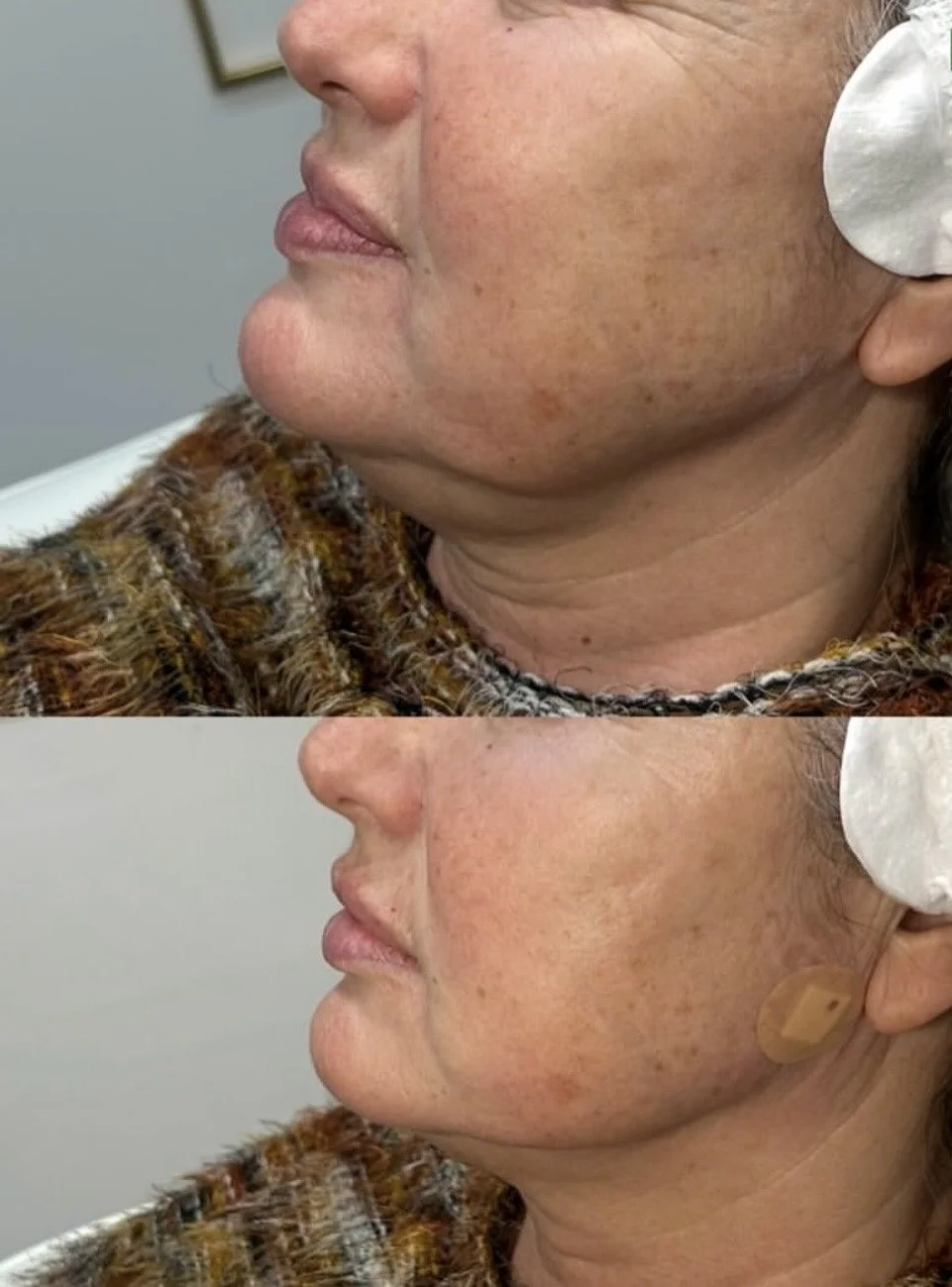 Side-by-side comparison of a woman's face showing before and after skin treatment, focusing on improved skin texture and reduced pigmentation. Pdo threads in the jawline to treat sagging.