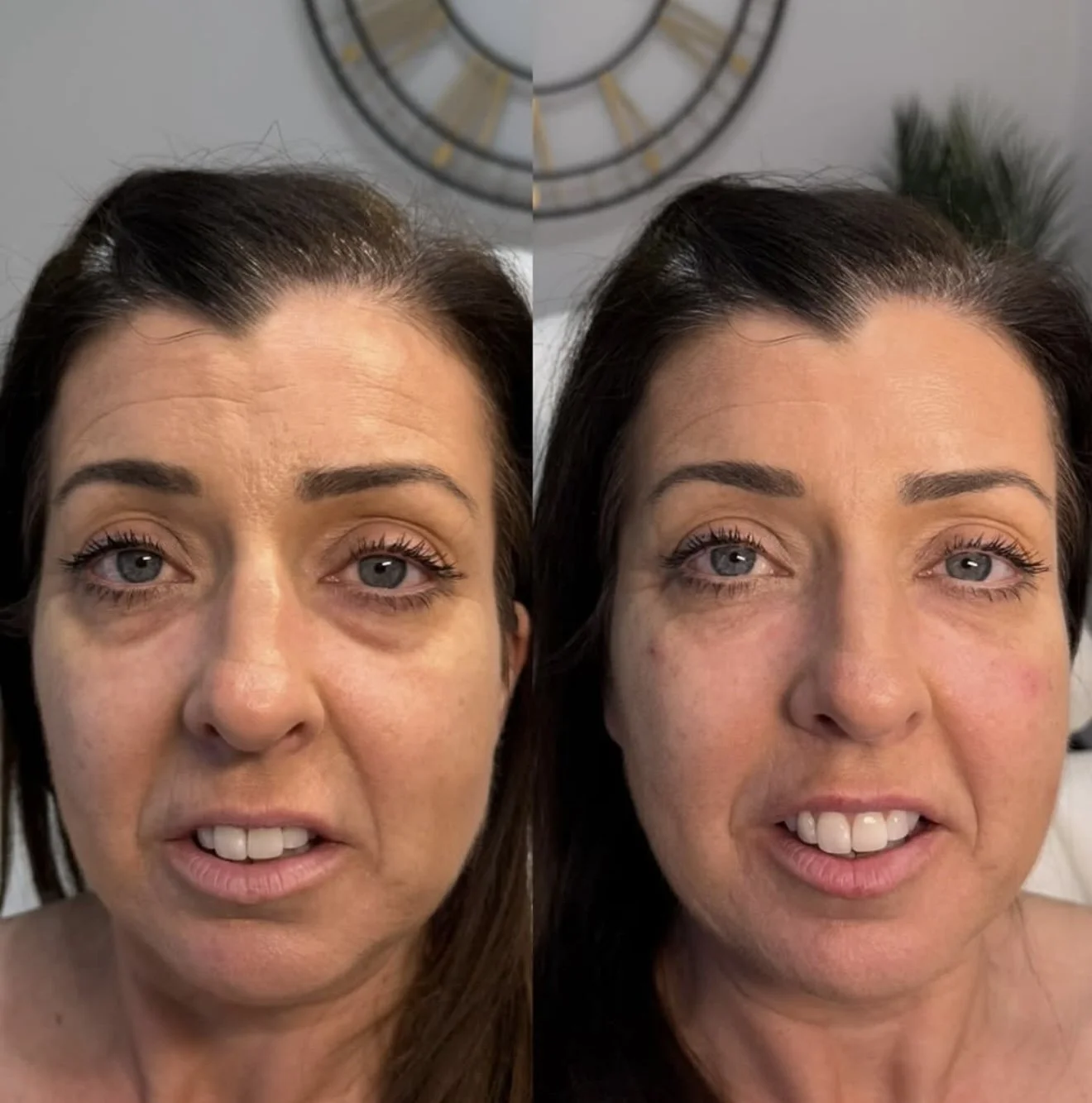 Comparison of a woman's face before and after cosmetic treatment, showing reduced signs of aging, smoother skin, and a more youthful appearance.