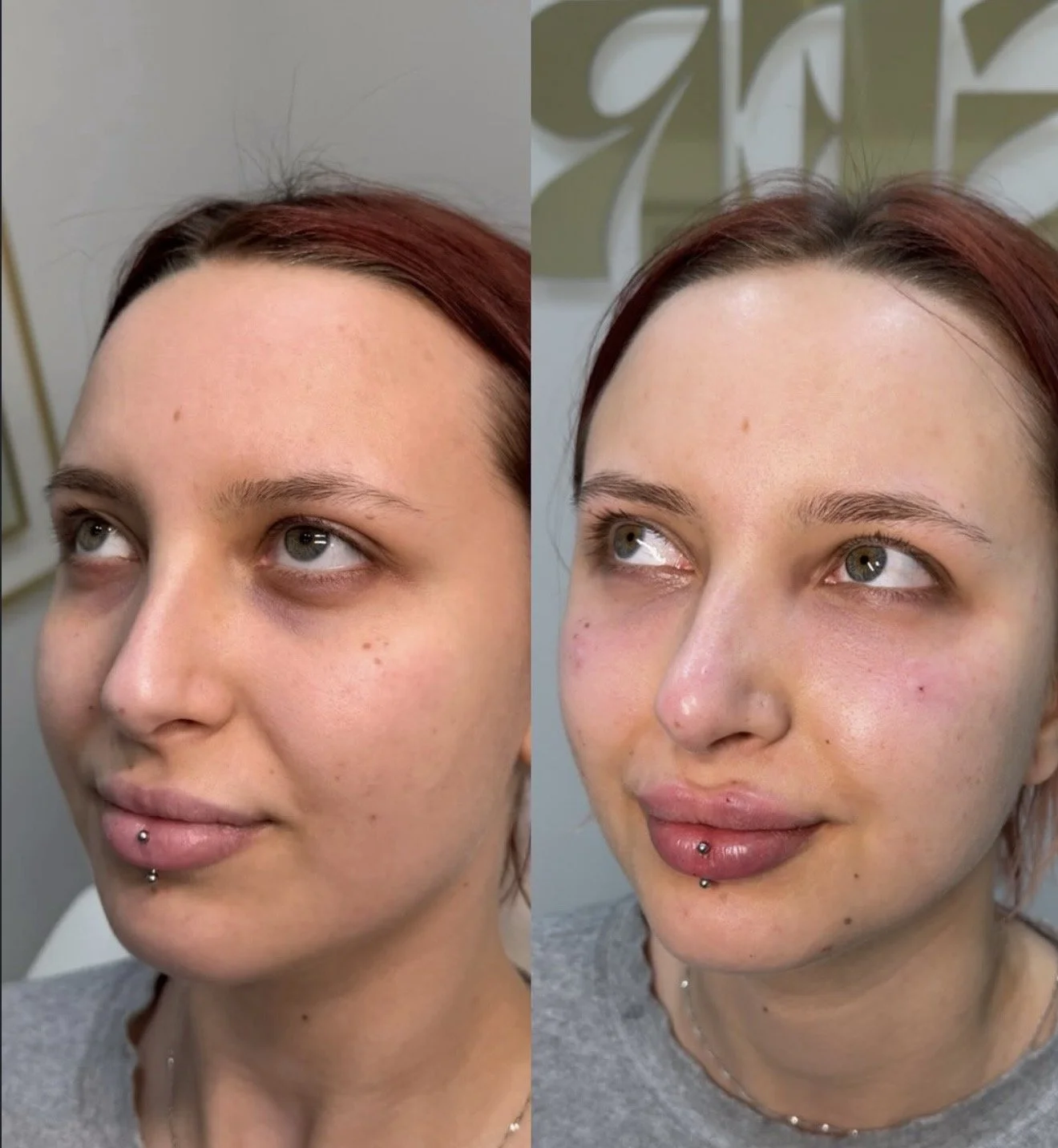 Comparison of a woman's face before and after a skincare or cosmetic treatment, showing clearer and more even skin in the after image.