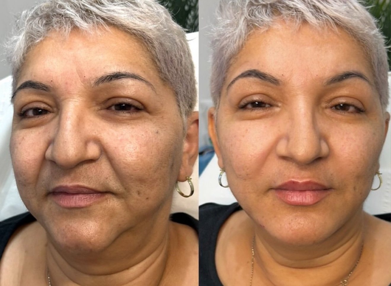 Side-by-side comparison of a woman's face showing a before and after skin treatment, revealing clearer, smoother skin and fewer blemishes. Full face dermal filler, smile line filler, nasolaobial filler, marionette line filler, lip filler.