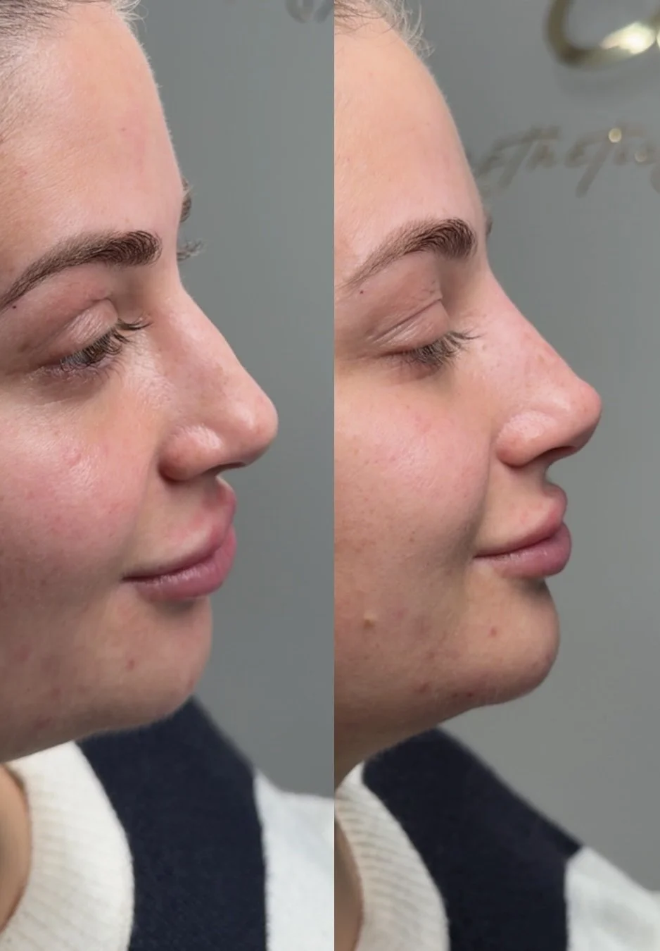 Side-by-side comparison of a woman's facial profile before and after a cosmetic procedure showing smoother skin and a refined nose shape.