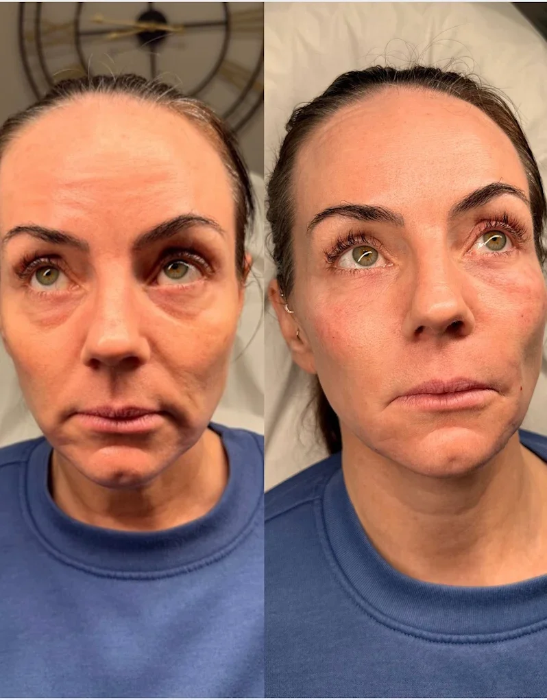 Side-by-side comparison of a woman's face before and after skincare treatment, highlighting reduced under-eye puffiness and smoother skin.