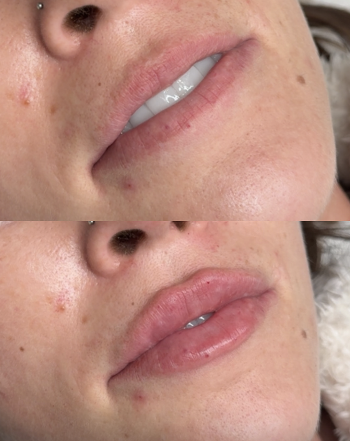 Close-up of a person's lips and surrounding skin, showing before and after pictures of lips with visible changes.