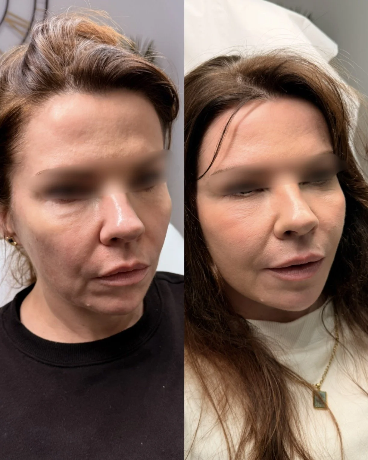 Side-by-side comparison of a woman before and after a cosmetic procedure, with her eyes closed in both images.