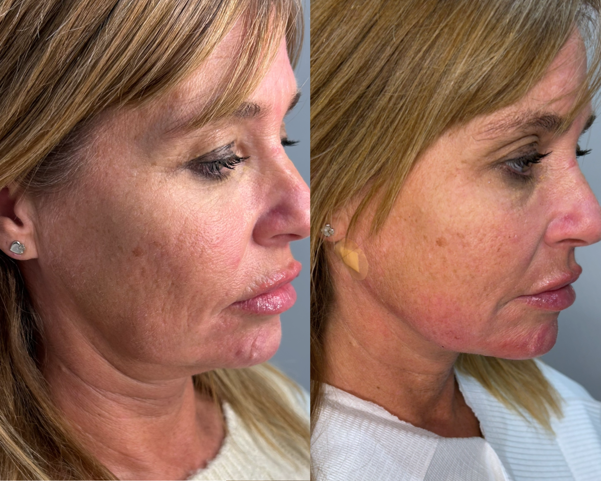 Side-by-side comparison of a woman's face before and after skincare treatment, showing improvements in skin texture and appearance.
