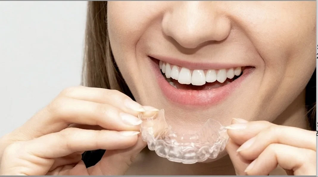 Why More Adults Are Choosing Clear Aligners for a Straighter Smile