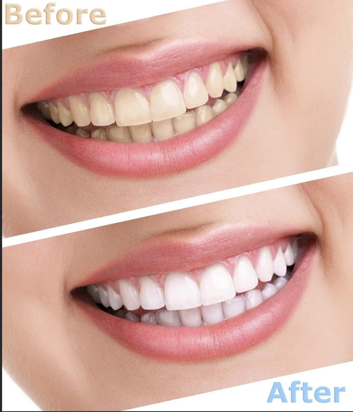 The Scoop On Whitening