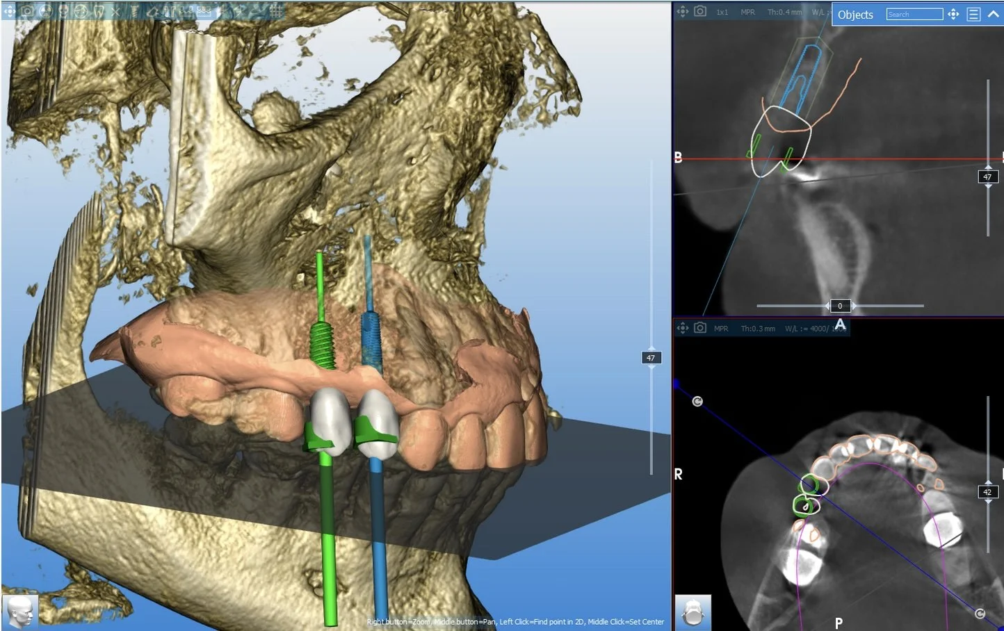 3D dental scan showing a skull with dental implants and surgical planning tools on a computer screen.