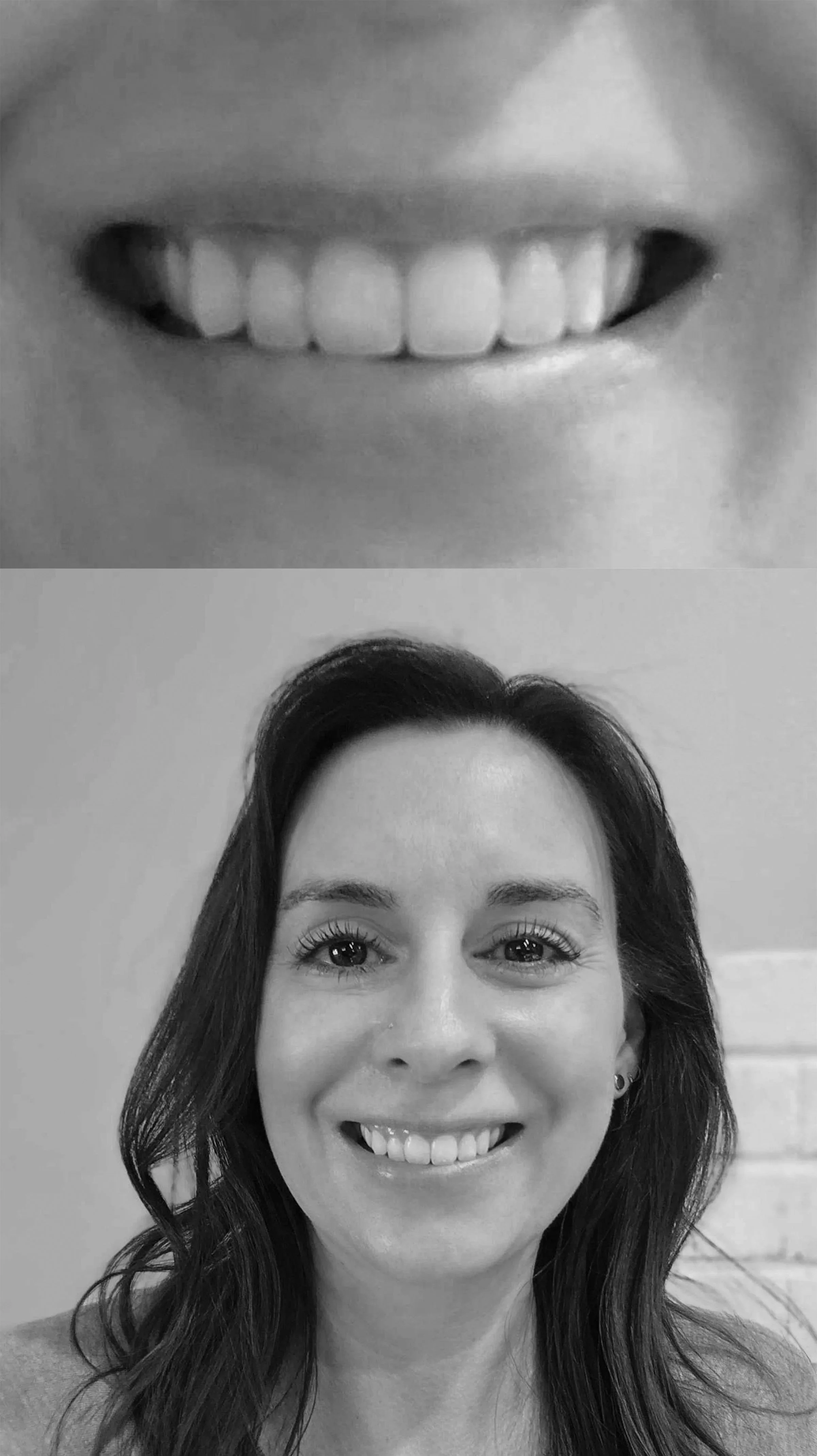 Black and white image of a smiling woman with long hair, and a close-up of her teeth in a separate section.