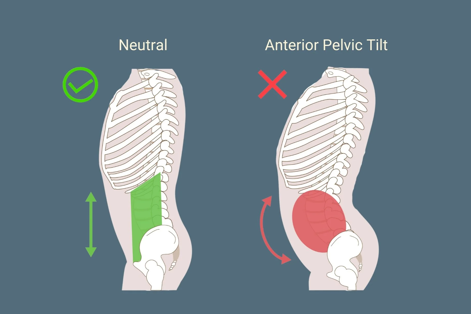 graphic showing a neutral pelvic vs anterior pelvis