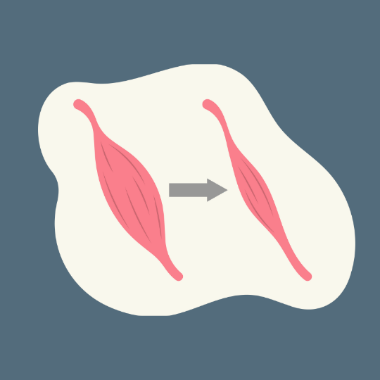 Graphic showing sarcopenia