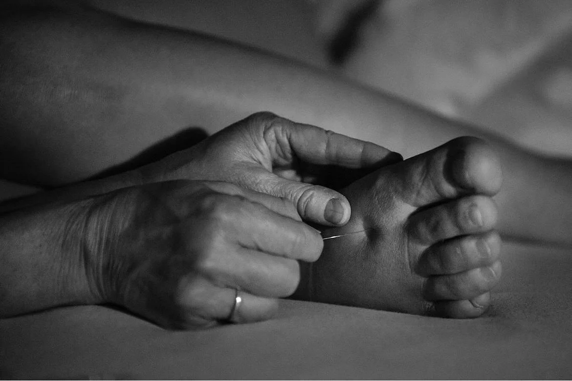 ✨ Acupuncture ✨

Acupuncture can be used in many settings for pregnancy &amp; labour and birth, and the postnatal period. 
 
 Acupuncture during pregnancy has been proven to be effective in helping mama relieve common conditions such as:
* Nausea
* M