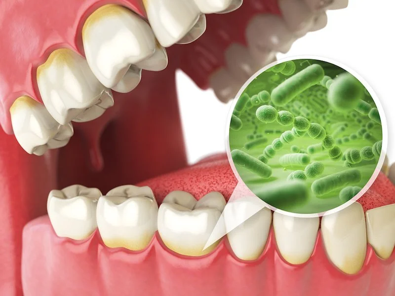 Is Gum Disease Actually Serious?