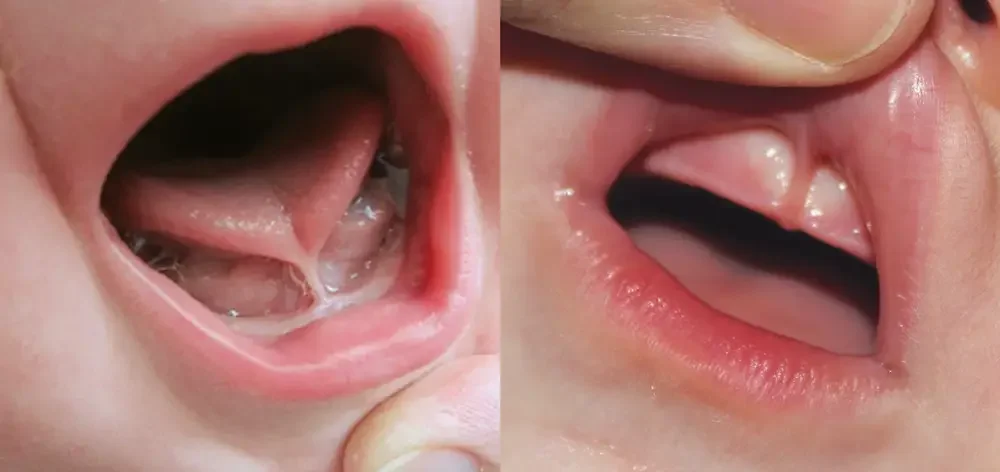 Frenectomy for Infants and Toddlers: What Parents Should Know