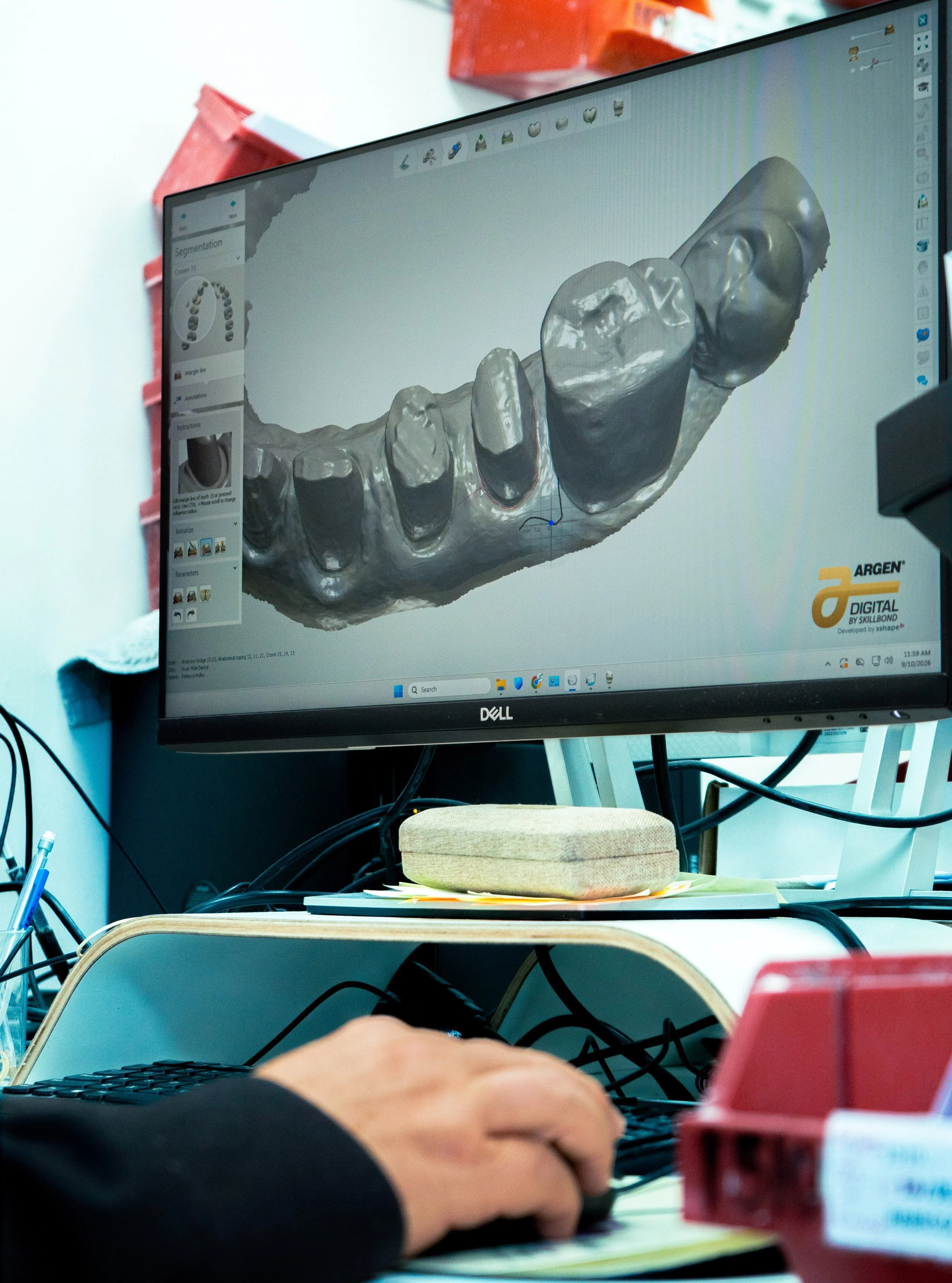 From traditional impressions to digital scans; whatever your workflow, Griffen Dental Laboratory has got you covered!