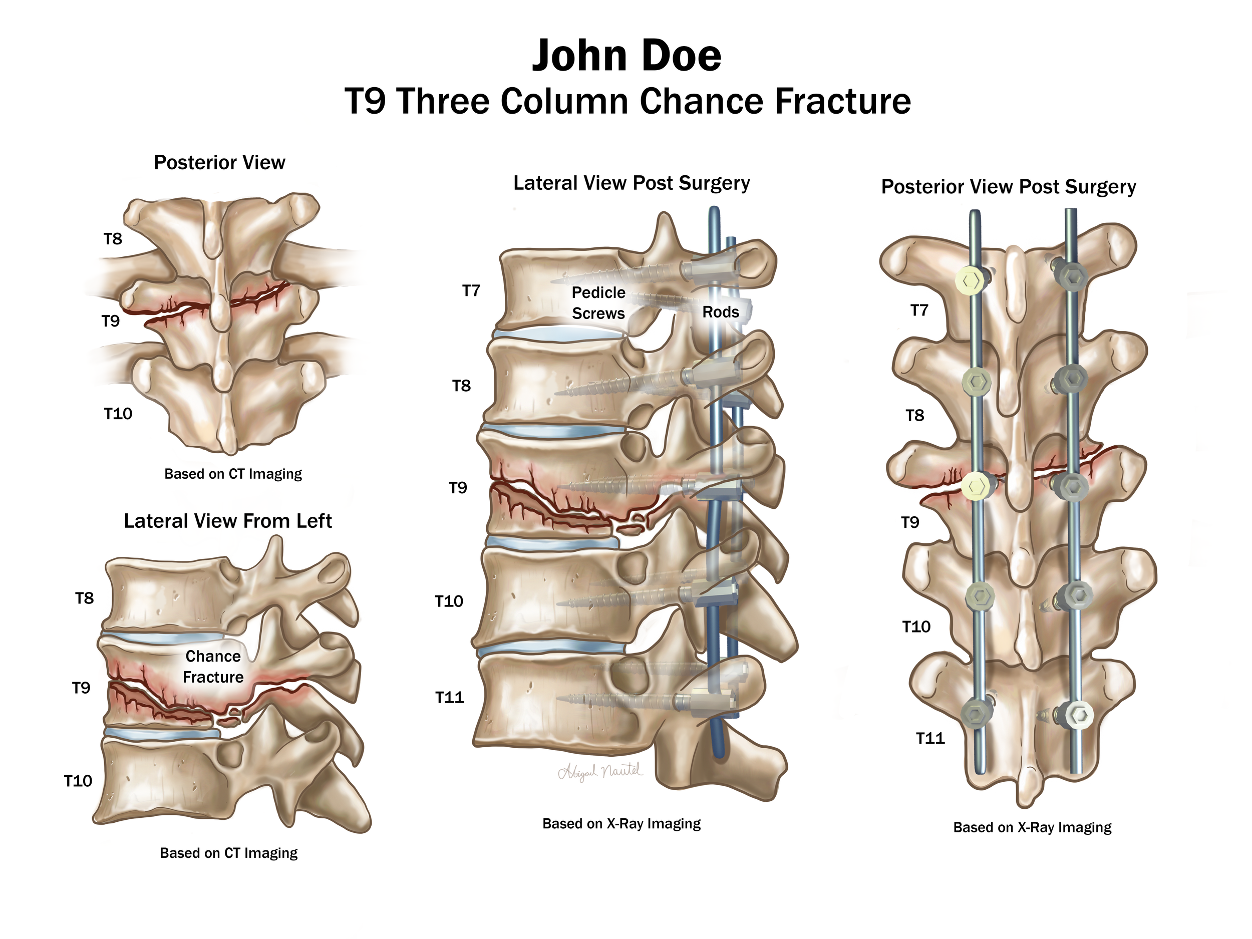 Med Legal Chance Fracture