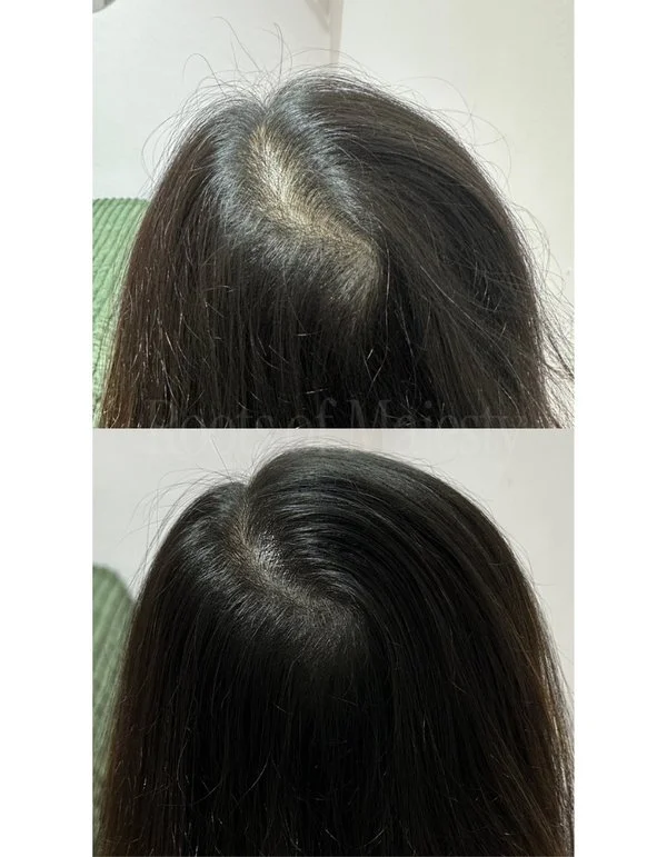 Scalp Micro Pigmentation SMP Singapore For Women Hairloss